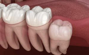 Các kiểu răng khôn mọc lệch gây đau đớn cho bạn