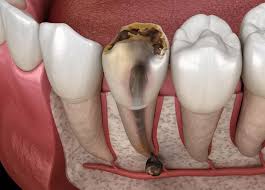 Các bệnh về tủy răng