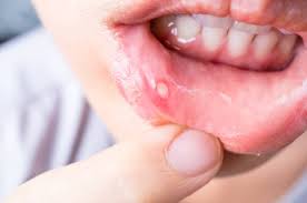 Tại sao trẻ bị viêm loét?