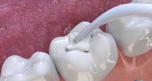 Tác dụng của thuốc diệt tủy
