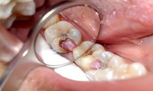 Diệt tủy răng có đau không? Những điều cần phải biết