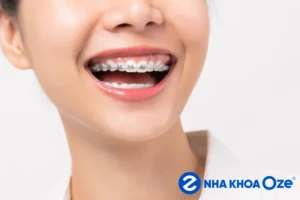niềng chỉnh răng không những có hàm răng đẹp mà còn có thể sở hữu cho mình chiếc cằm V-line