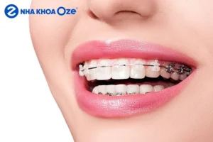 [Giải đáp] Niềng răng có làm thay đổi khuôn mặt không?