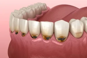 Giải đáp thắc mắc: Bị mòn chân răng phải làm sao?