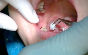 Răng cấm bị lung lay nên nhổ hay không? Biện pháp xử lý an toàn