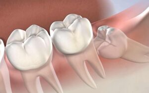 Dấu hiệu răng khôn mọc lệch mà bạn dễ dàng nhận biết nhất
