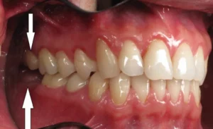 Răng cấm là răng nào? Có mấy chân, khác gì khăn khôn