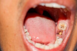 Răng cấm bị bể: Biến chứng khó lường & Cách phòng ngừa