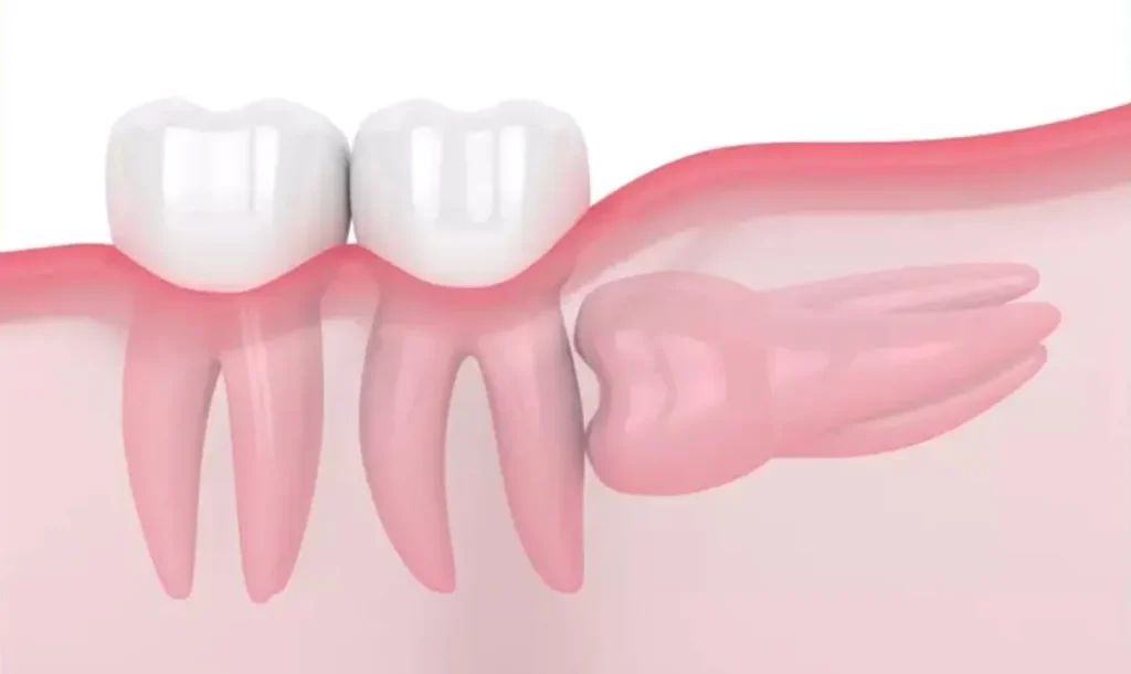 Nhổ răng khôn có đau không?