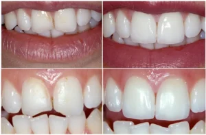 Mách bạn cách phục hồi răng bị mẻ tại nhà