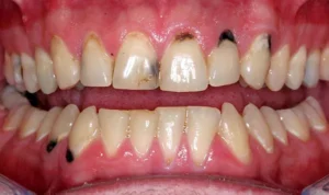 Răng chết tủy là gì? Nhổ răng chết tủy có đau không?