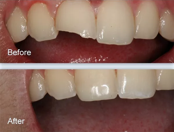 Thực hiện trám răng bị mẻ