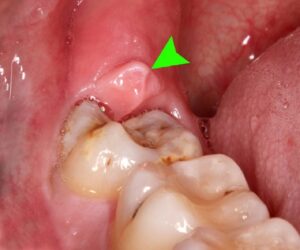 Viêm lợi trùm răng khôn có mủ là bệnh gì, cách chữa trị như thế nào?