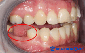 Mất răng số 6