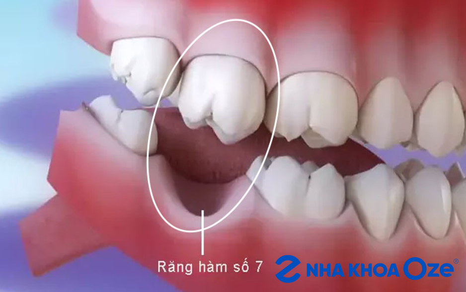Mất răng số 7