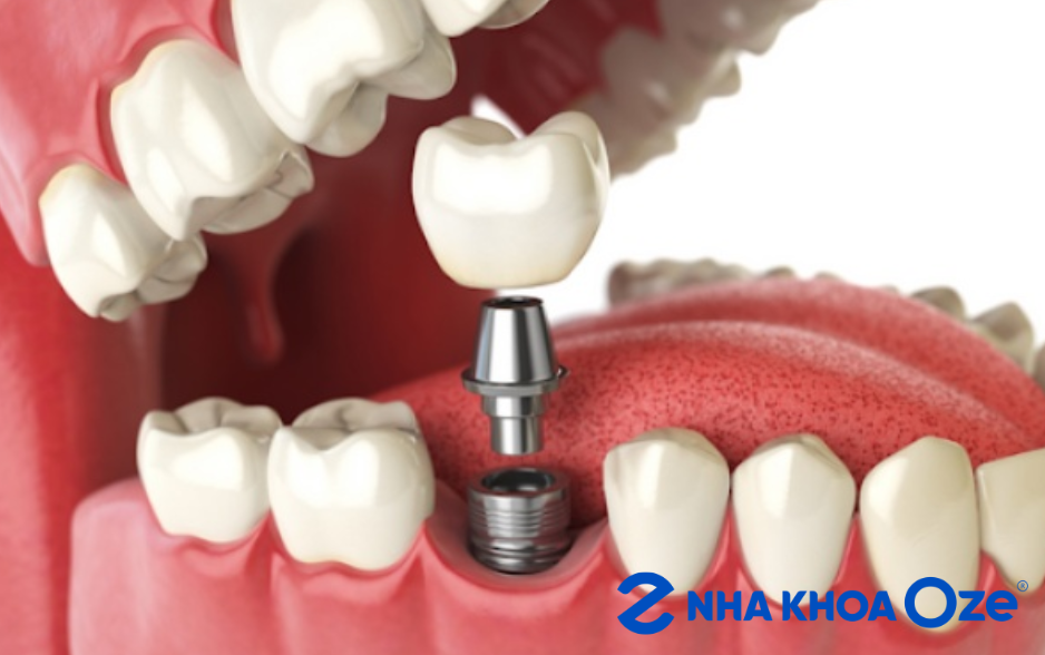 Răng giả 1 chiếc lắp trên Implant