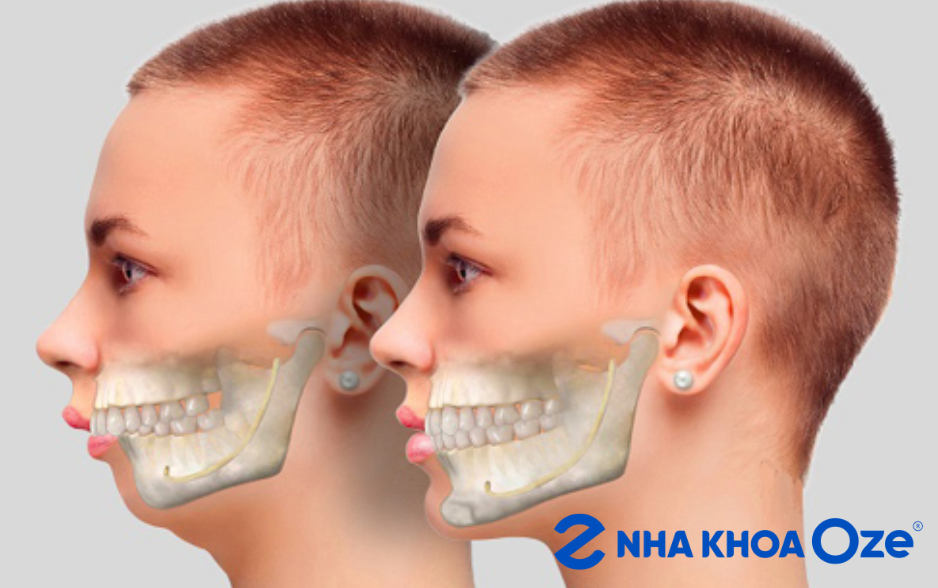 Ảnh minh họa răng bị vẩu, chìa ra ngoài mất thẩm mỹ