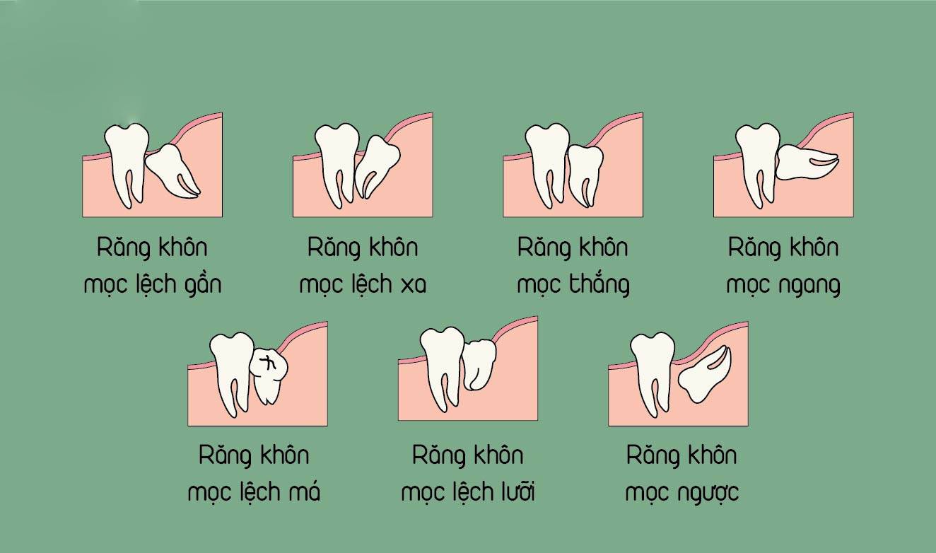 So sánh chi phí nhổ răng khôn mọc lệch và mọc thẳng