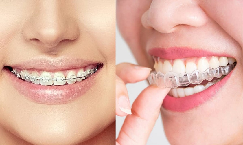 So sánh niềng răng trong suốt và mắc cài. Niềng răng trong suốt khác gì mắc cài?