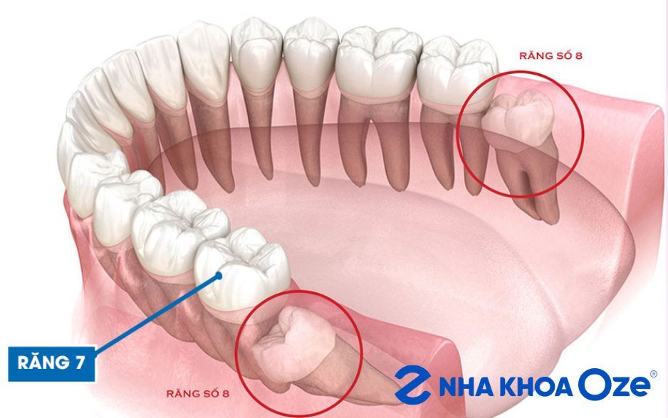Nhổ răng khôn không đau Sóc Sơn