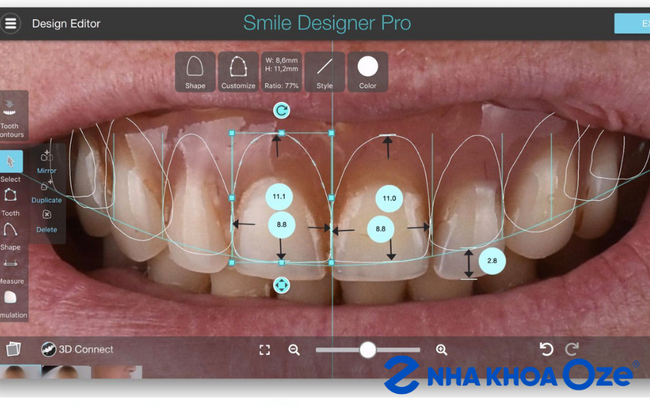 Phần mềm thiết kế nụ cười Smile Design