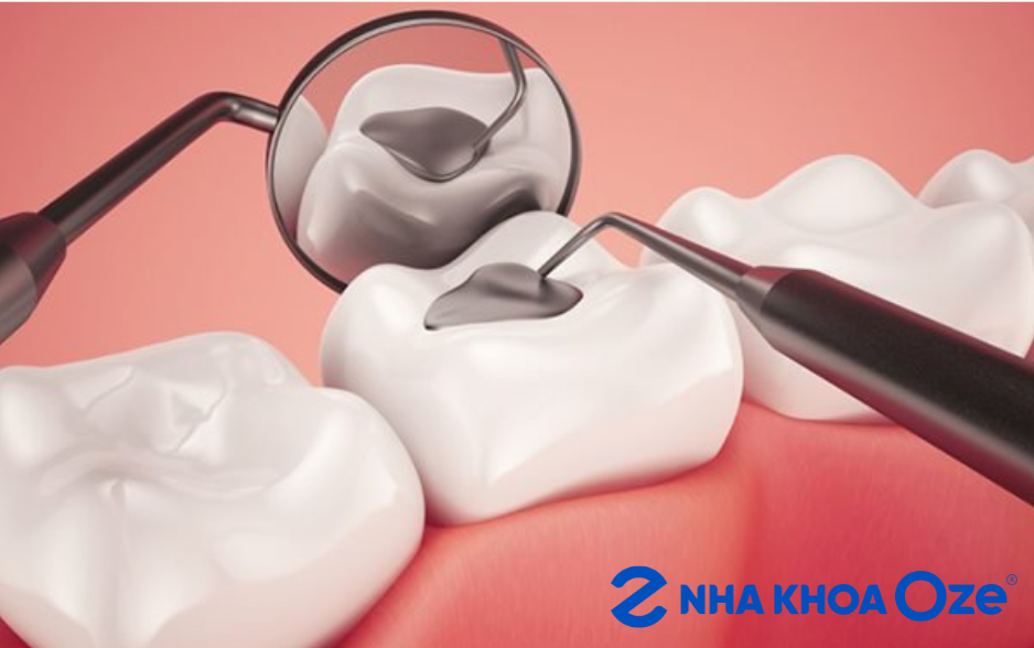 Hàn răng giá rẻ Sóc Sơn tại nha khoa Oze