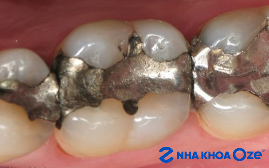 Amalgam có độ bền cơ học tốt