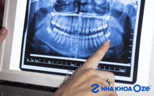 Nhổ Răng Khôn Giá Bao Nhiêu Tại Hà Nội? Cập Nhật 2025 Từ Nha Khoa Oze