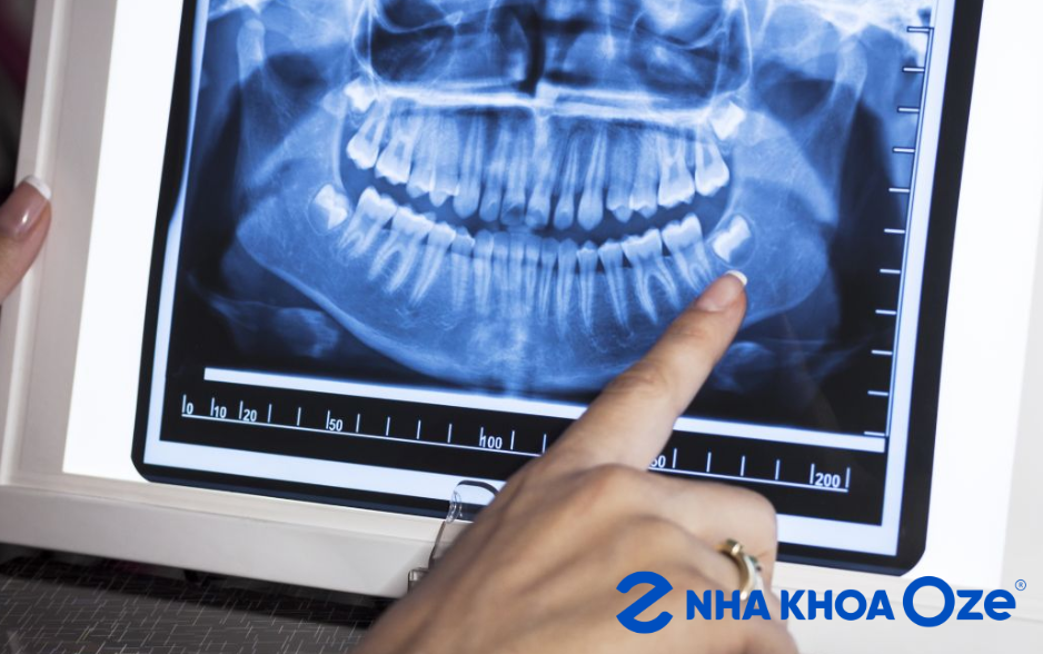 Địa chỉ nhổ răng khôn lệch Đông Anh