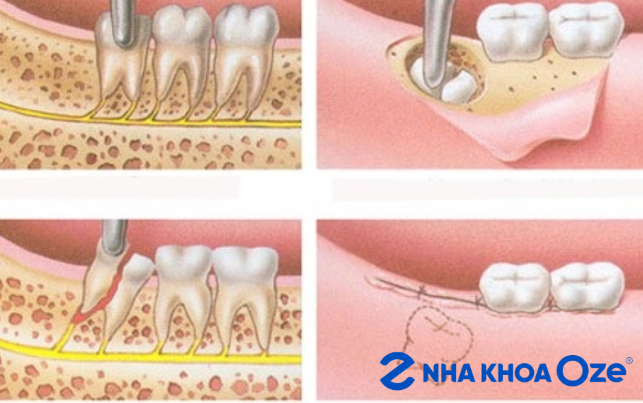 Công nghệ Piezotome sử dụng sóng siêu âm tần số cao để bóc tách, cắt và nhổ răng một cách nhẹ nhàng mà không làm tổn thương mô mềm
