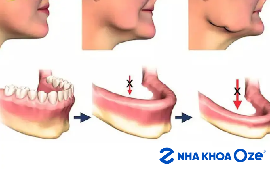 Mất răng lâu ngày sẽ dẫn đến tình trạng tiêu xương