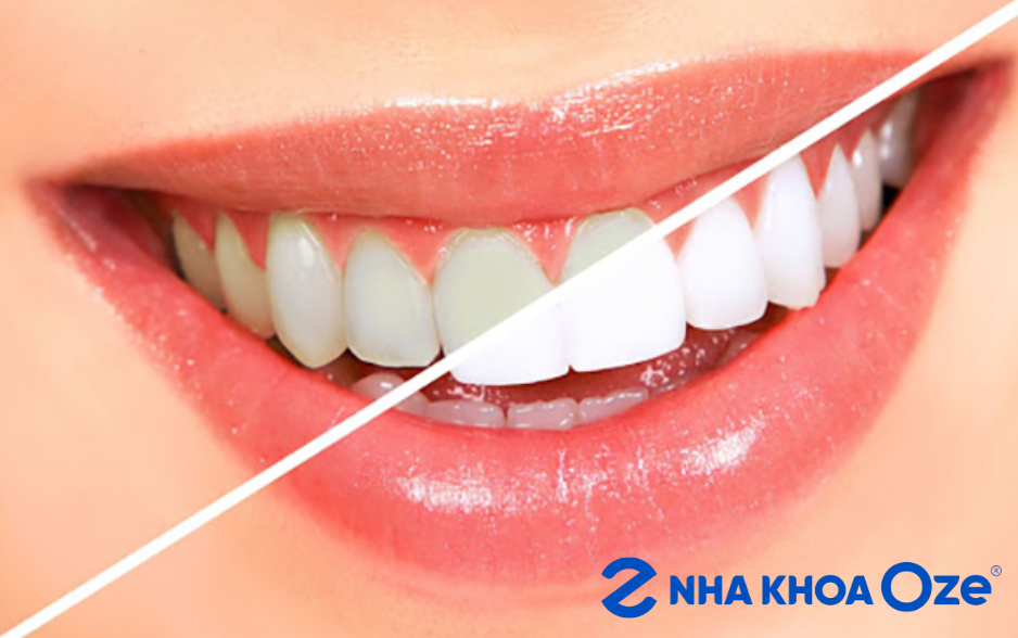 Bọc răng sứ thẩm mỹ Hà Nội