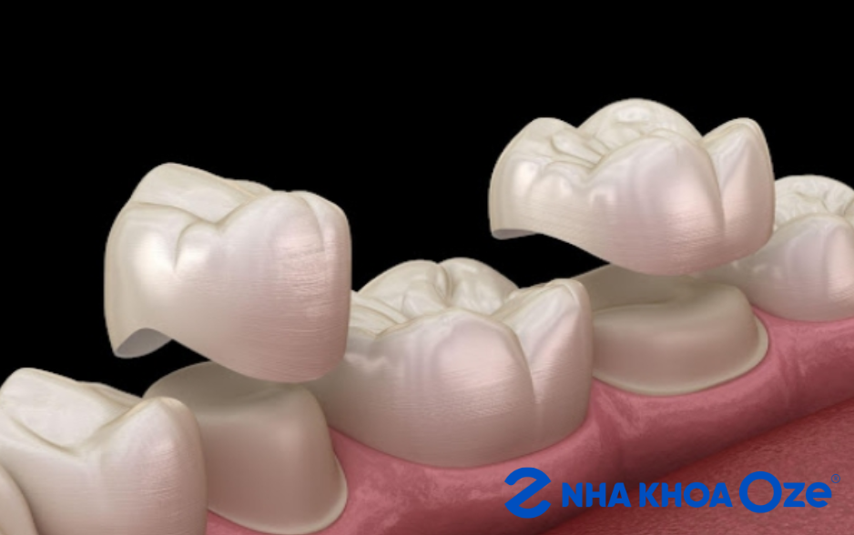 Ảnh minh họa bọc sứ