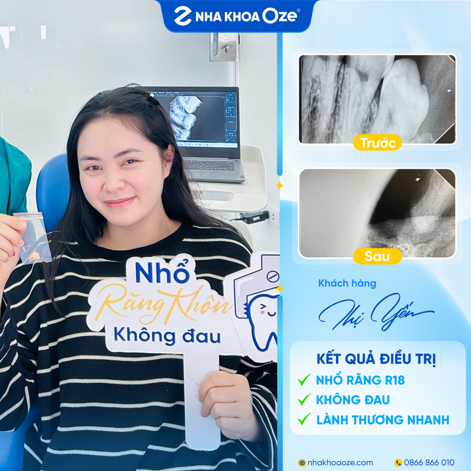Rất nhiều khách hàng đã trải nghiệm dịch vụ nhổ răng khôn không đau tại Oze
