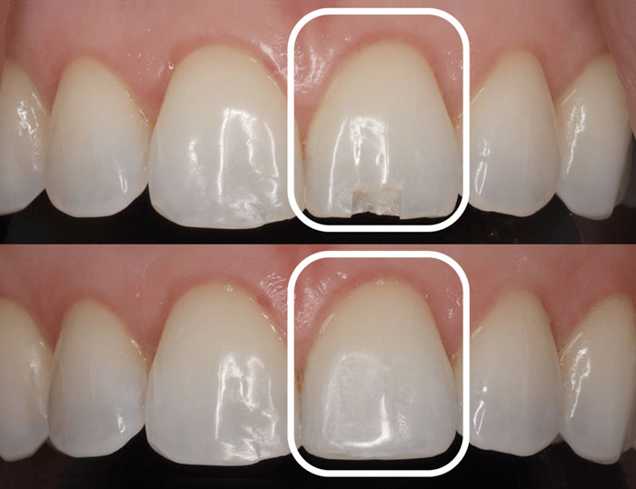 Hình ảnh trước sau trám răng thẩm mỹ Đông Anh