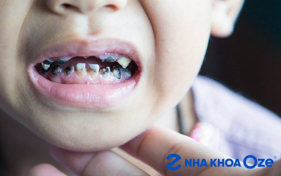 Bé có lỗ sâu, ê buốt, nhai lệch một bên hoặc răng mẻ là lúc nên đi khám sớm