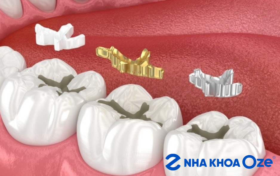 Vật liệu trám phù hợp cần được lựa chọn theo mức độ sâu răng, vị trí răng và độ tuổi của bé