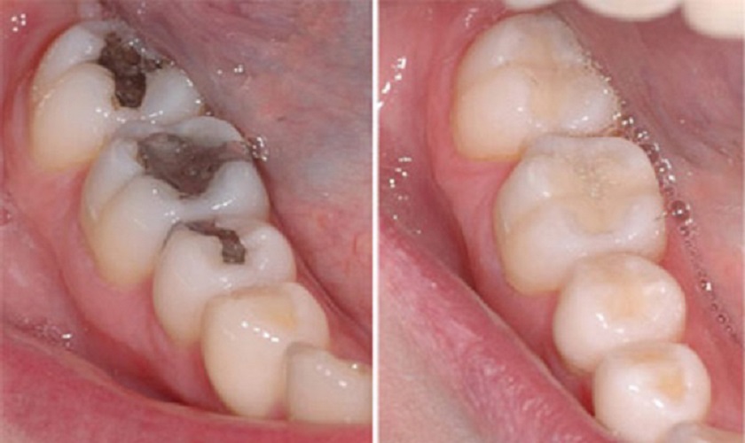 Kết quả thực tế sau khi hàn răng giá rẻ Sóc Sơn tại nha khoa Oze