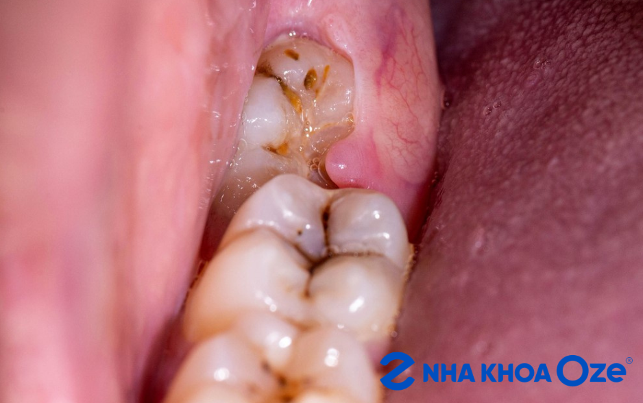 Giá nhổ răng khôn tại Sóc Sơn tùy theo từng mức độ