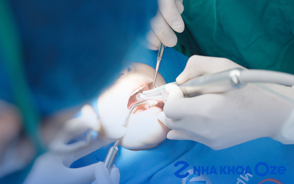 Công nghệ Piezotome hỗ trợ nhổ răng khôn tại Nha khoa Oze Đông Anh