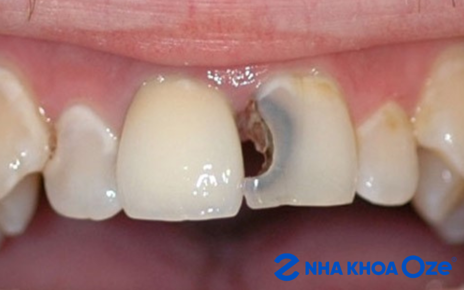 Răng cửa sứt nhẹ và răng thưa nhẹ có thể trám thẩm mỹ