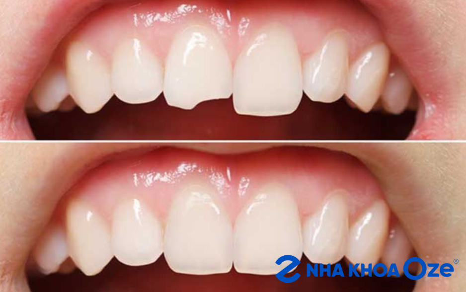 Kết quả trám răng cửa sứt nhẹ bằng Composite