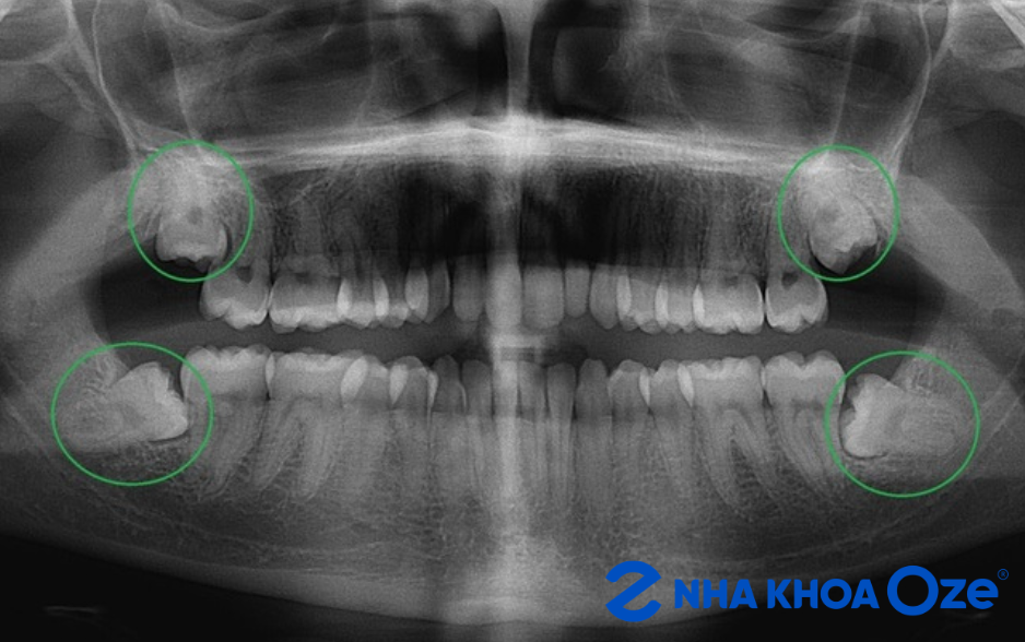 Răng khôn mọc lệch mọc ngầm cần đánh giá trước khi nhổ