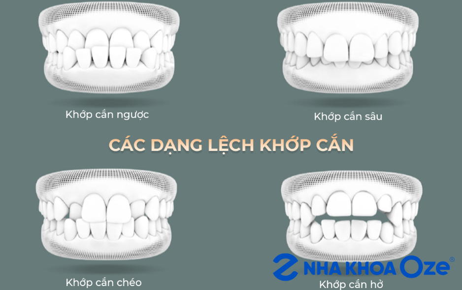 bác sĩ đánh giá mức độ lệch lạc răng trước khi lên chi phí niềng