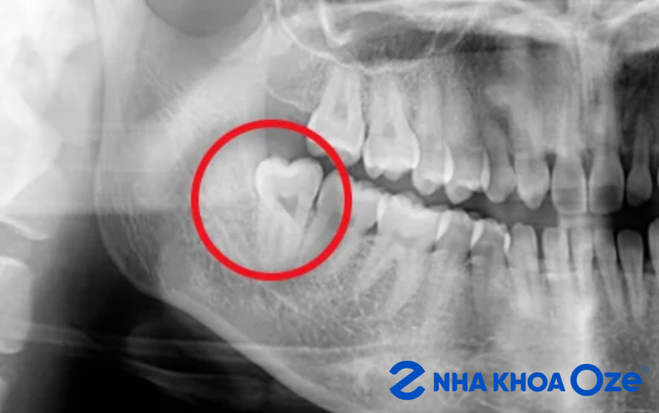 răng khôn mọc thẳng có thể cân nhắc trám phục hồi