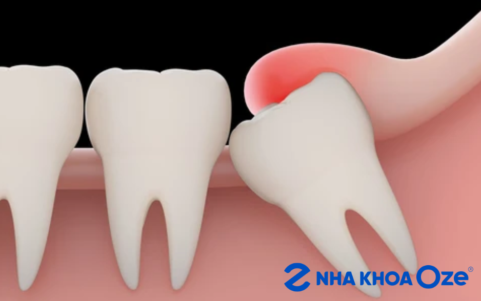 răng khôn mọc lệch chèn vào răng số 7