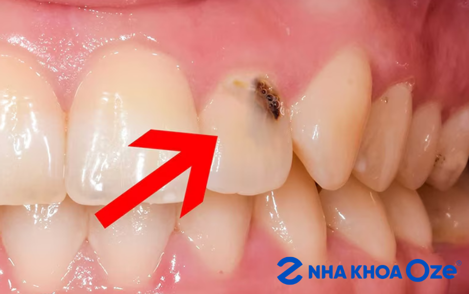 răng sữa sâu nhẹ cần kiểm tra sớm