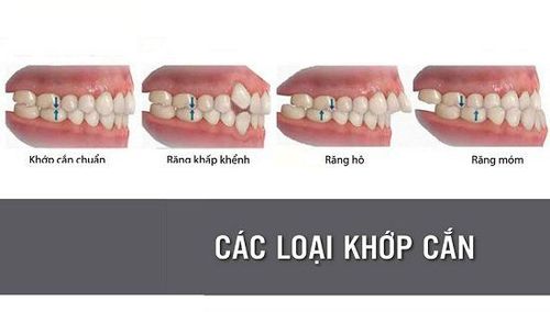 Tình trạng lệch khớp cắn hàm trên dưới không khớp