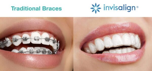 So sánh niềng răng mắc cài và niềng răng trong suốt tại Sóc Sơn