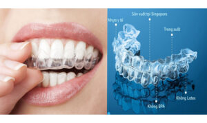 Niềng răng trong suốt tại Sóc Sơn 2026 – Thẩm mỹ cao, tháo lắp linh hoạt